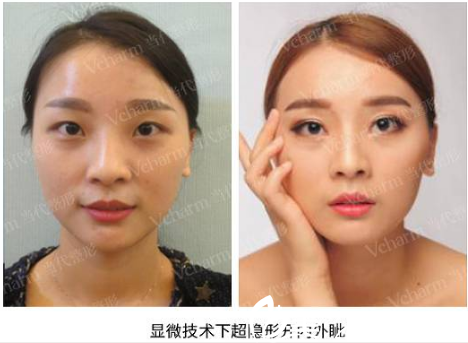 刘辅蓉显微技术下超隐形双眼皮案例