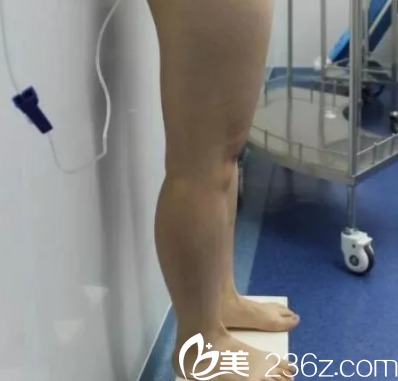 在北京樱桃做腿部吸脂前样子 在北京樱桃做腿部吸脂前样子