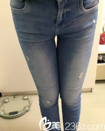 北京樱桃腿部吸脂 北京樱桃腿部吸脂