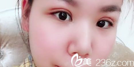 我于2018国庆节找丽水樊承红做了全切双眼皮和去皮去脂手术,现在又准备做鼻子啦