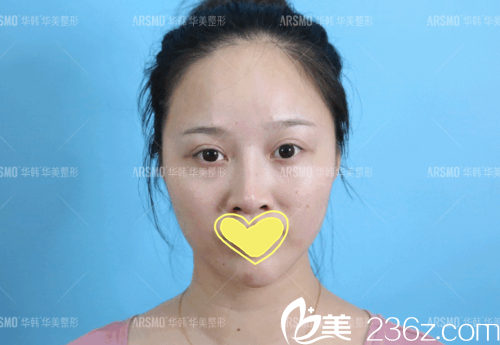 次做鼻整形失败的我的术前照 次做鼻整形失败的我的术前照