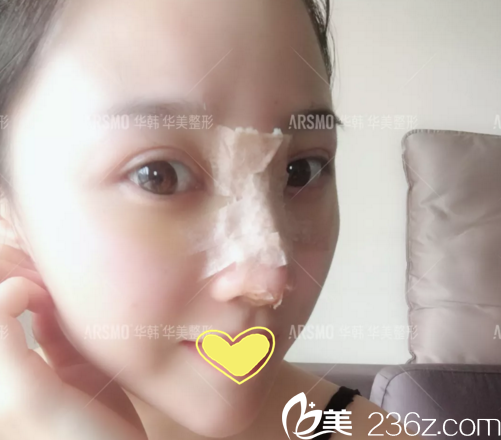 做鼻修复术后第3天<span style= 做鼻修复术后第3天<span style=