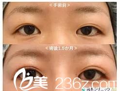 切开法双眼皮 切开法双眼皮