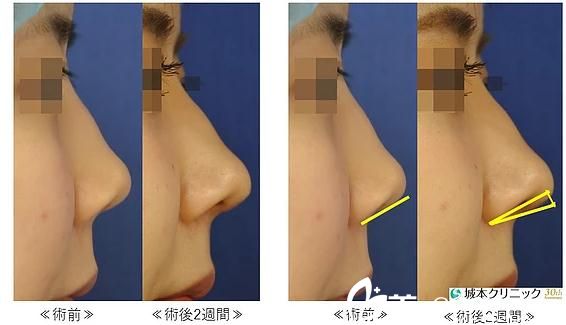 鼻中隔延长 鼻中隔延长