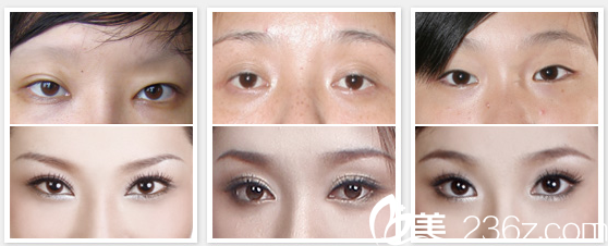 崔培培双眼皮案例 崔培培双眼皮案例