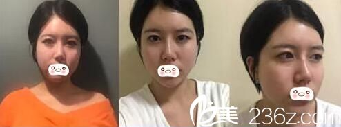 术前严重的大小眼 术前严重的大小眼