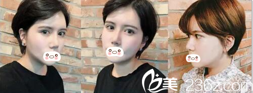 术后2周面部肿胀 术后2周面部肿胀