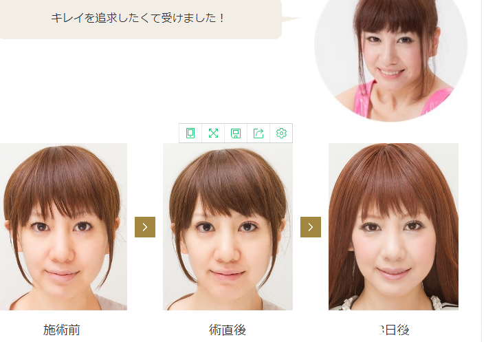 埋线双眼皮 埋线双眼皮