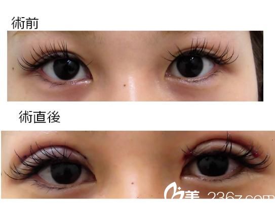 切开法双眼皮