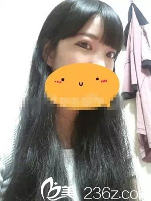 郭峰医生双眼皮手术案例