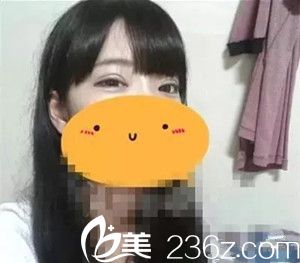 双眼皮术后一个月