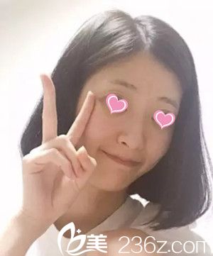 隆鼻手术前 隆鼻手术前