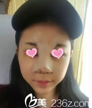 术后三天 术后三天