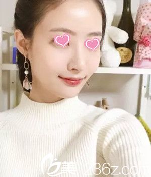 假体隆鼻后15天 假体隆鼻后15天