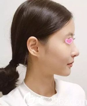 隆鼻后侧面照 隆鼻后侧面照