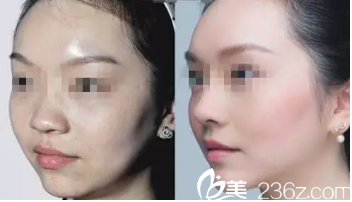 吴豫芳医师微整形除皱案例 吴豫芳医师微整形除皱案例