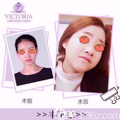 杭州维多利亚余英玻尿酸丰下巴案例 杭州维多利亚余英玻尿酸丰下巴案例