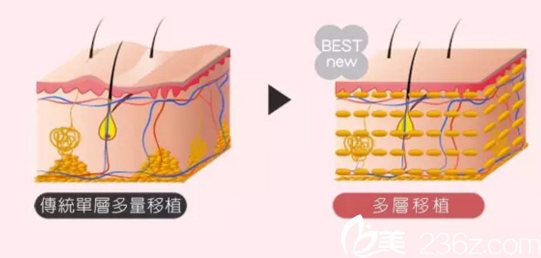 纳米自体脂肪填充的优势 纳米自体脂肪填充的优势