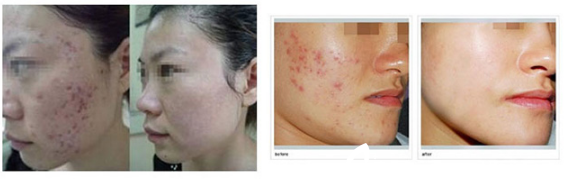 红蓝光祛痘前后对比案例 红蓝光祛痘前后对比案例