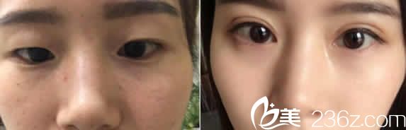 聊城韩美整形双眼皮加开眼角案例效果图