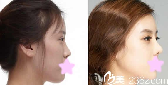 聊城韩美整形鼻综合隆鼻效果图