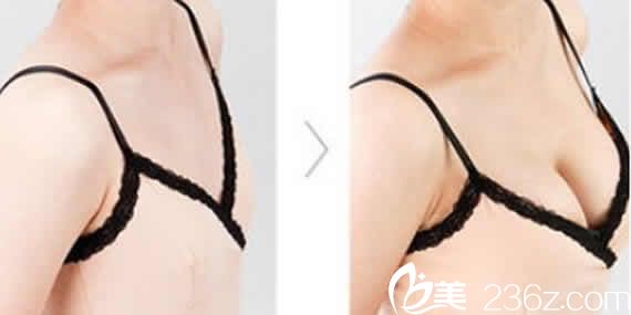 聊城韩美整形自体脂肪隆胸前后对比图