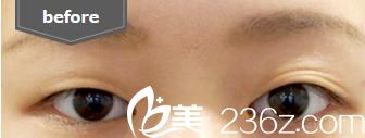埋线法双眼皮 前 埋线法双眼皮 前