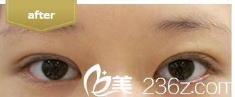 埋线法双眼皮 埋线法双眼皮