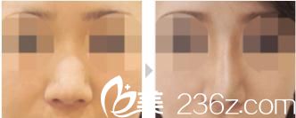 综合隆鼻 综合隆鼻