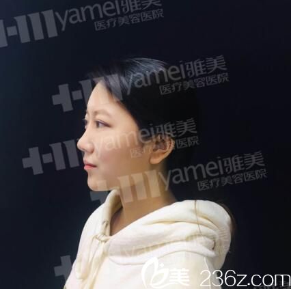 在长沙雅美注射瘦脸术前照 在长沙雅美注射瘦脸术前照