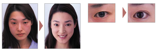 20181106_1541484046888613.png 双眼皮.png