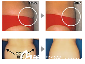 20181106_1541484328495947.png 吸脂.png