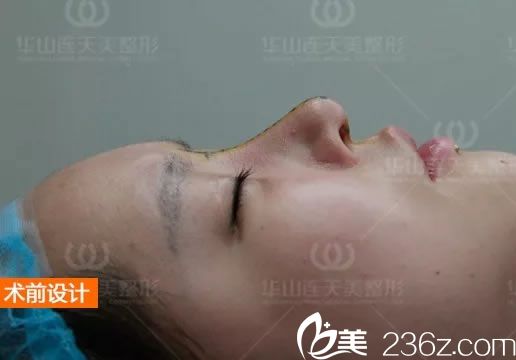 <!--<i data=20240703-sp></i>-->主任为我设计的鼻修复方案 <!--<i data=20240703-sp></i>-->主任为我设计的鼻修复方案