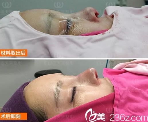 隆鼻后假体取出的照片 隆鼻后假体取出的照片