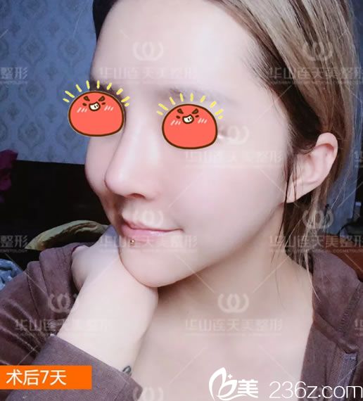 第4次鼻修复手术7天恢复照 第4次鼻修复手术7天恢复照