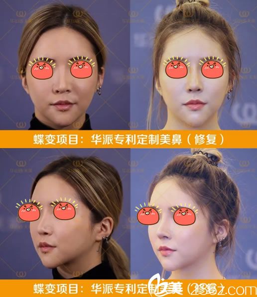 杭州连天美<!--<i data=20240703-sp></i>-->高难度鼻修复案例 杭州连天美<!--<i data=20240703-sp></i>-->高难度鼻修复案例