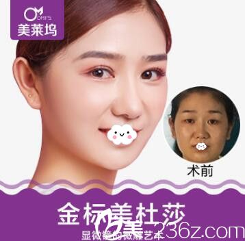 淮北东方美莱坞割双眼皮术前术后真实效果对比