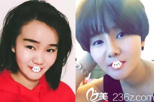 淮北东方美莱坞隆鼻整形真人案例