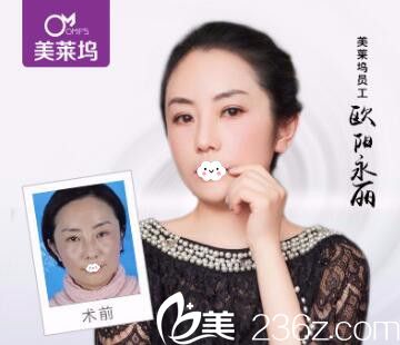 淮北东方美莱坞注射瘦脸除皱瘦脸真人案例效果图