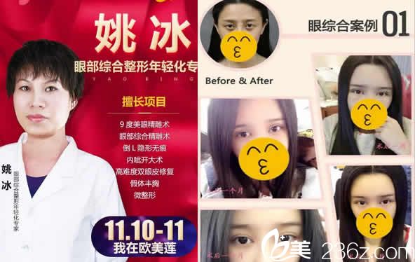 太原欧美莲整形姚冰及双眼皮案例图