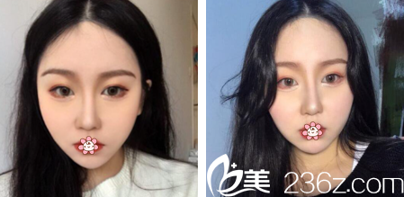 重庆曹阳丽格整形面部吸脂怎么样