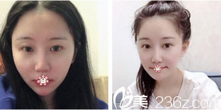 在重庆曹阳丽格整形陈滔那儿做完面部吸脂瘦脸9个月后我写了这个日记。