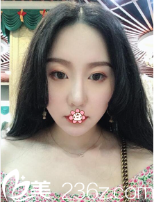 重庆曹阳丽格整形陈滔面部吸脂术后三个月