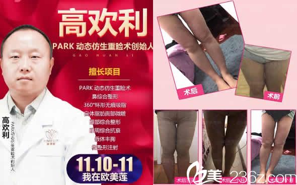 太原欧美莲整形高欢利及腿部吸脂塑形效果图