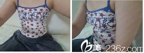 假体隆胸前照片 假体隆胸前照片