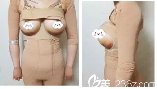 假体隆胸手术后3天 假体隆胸手术后3天