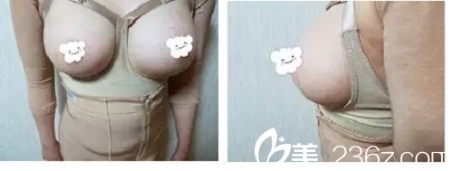 郭峰给我做假体隆胸手术一个月了 郭峰给我做假体隆胸手术一个月了