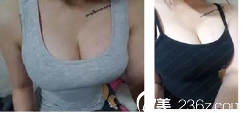 术后三个月 术后三个月