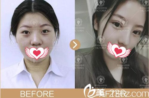 南京维多利亚整形双眼皮+鼻综合+玻尿酸案例效果 南京维多利亚整形双眼皮+鼻综合+玻尿酸案例效果