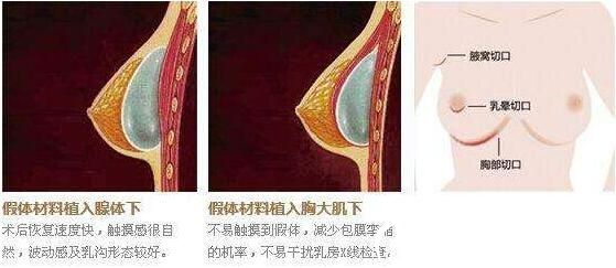 上海爱莫儿医疗美容门诊部假体隆胸原理